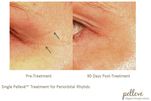before and after Pelleve treatment eyes