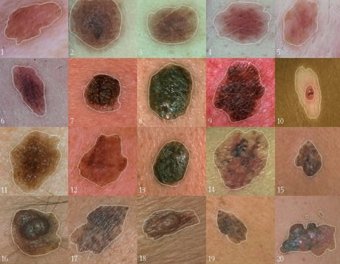 skin-cancer