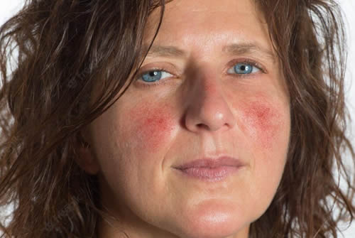 Discovering the Effectiveness of the Latest Rosacea Treatments
