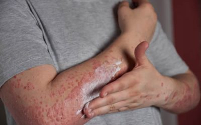 Understanding Psoriasis: Causes, Symptoms, Diagnosis, and Treatment