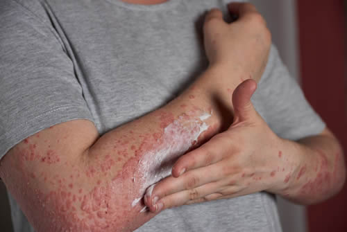 Understanding Psoriasis: Causes, Symptoms, Diagnosis, and Treatment