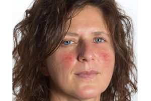 rosacea-on-cheeks