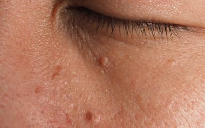 Skin Tags: Understanding These Common Skin Growths