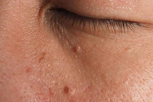 Skin Tags: Understanding These Common Skin Growths