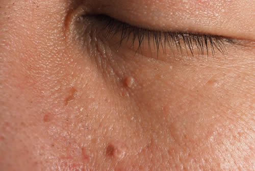 Skin Tags Understanding These Common Skin Growths Coast Dermatology