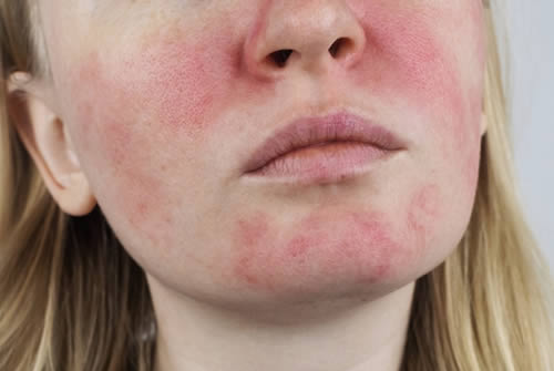 rosacea on female face