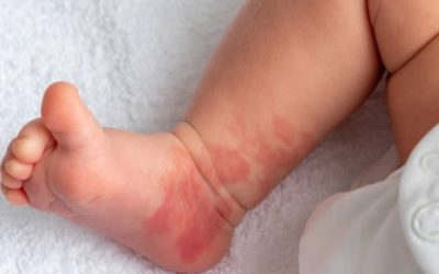 What You Need to Know About Birthmarks