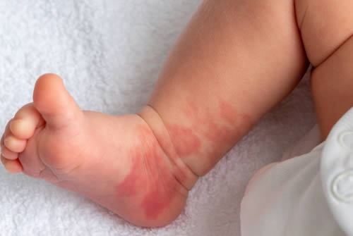birthmark on baby leg