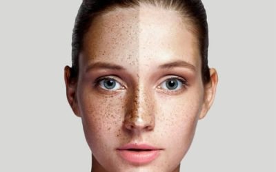 Melasma: The Mask You Can’t Take Off