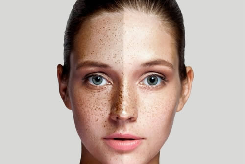 melasma on face