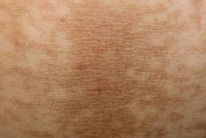 Acanthosis Nigricans on skin