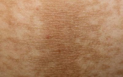 The 101 on Acanthosis Nigricans