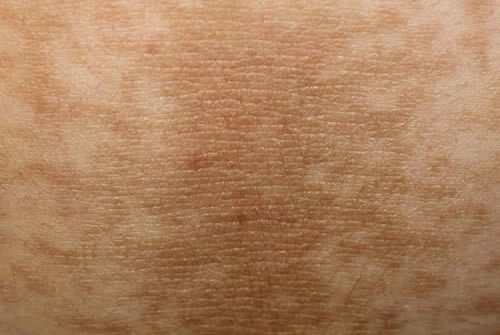 Acanthosis Nigricans on skin