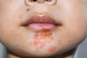 Impetigo on face