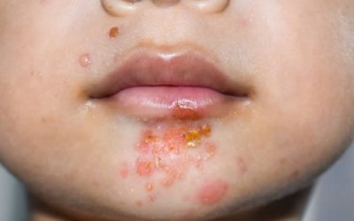 The Gross Truth About Impetigo