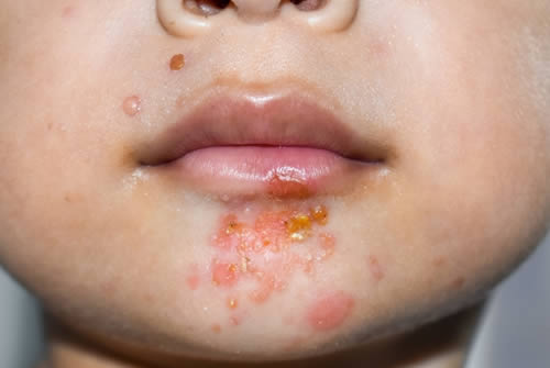 The Gross Truth About Impetigo Coast Dermatology And Skin Cancer Center