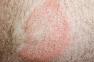 granulomas on skin