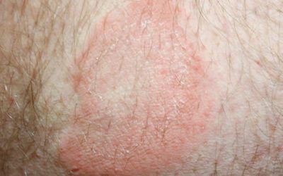 What are Granulomas?