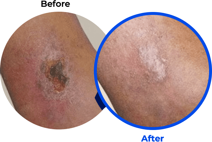 leg_ulcer leg ulcer