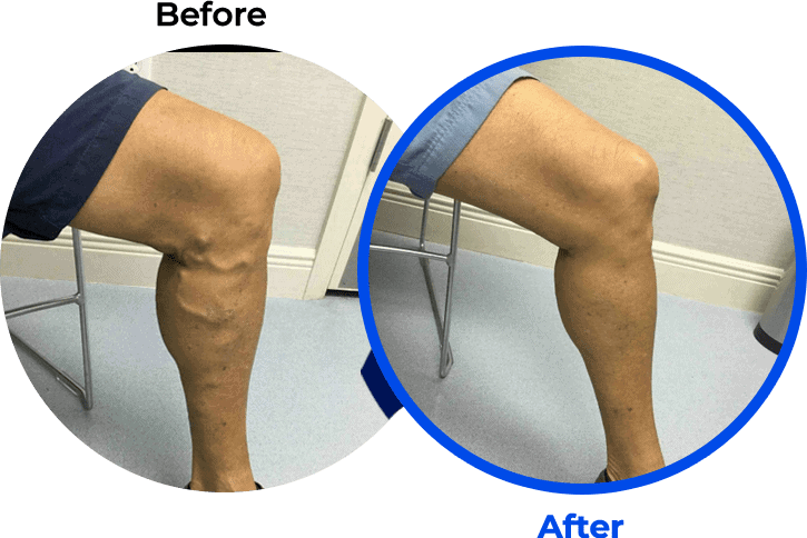 varicose_veins varicose veins