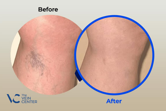 vien treatment before and after