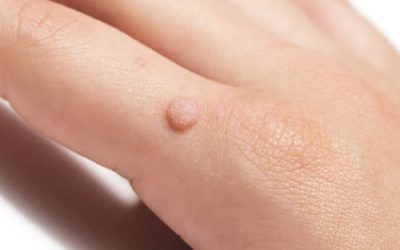 Worried About Warts?