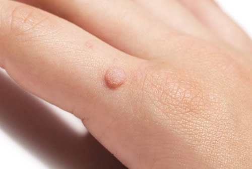 wart on hand