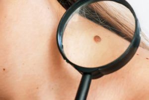 Skin Cancer Checks on shoulder