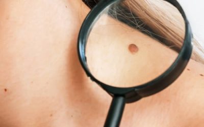The Importance of Regular Skin Cancer Checks
